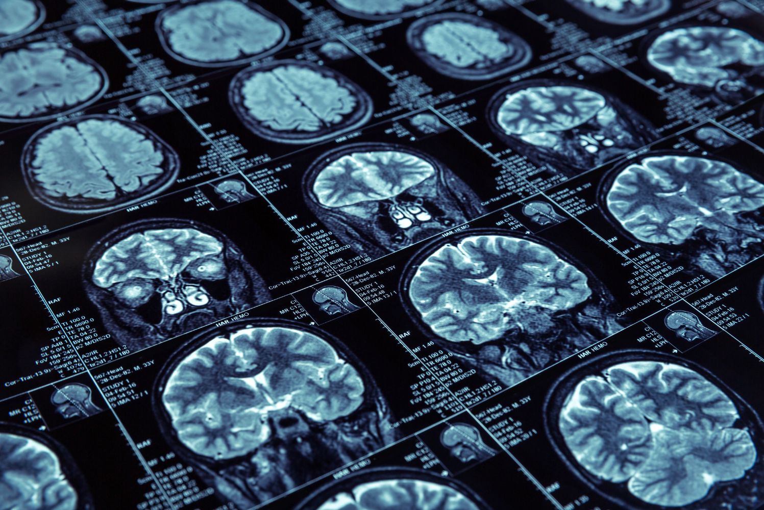 L’impact d’un implant cérébral sur la vie d’une patiente souffrant d’épilepsie et de TOC.